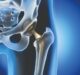 The development of the next generation of artificial joints