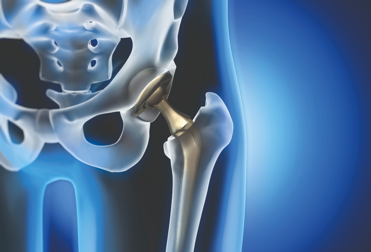 The development of the next generation of artificial joints