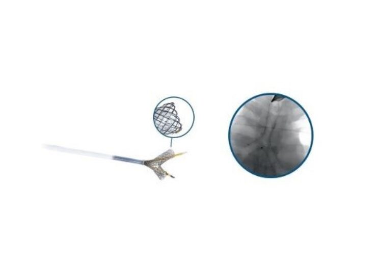 Micro-Tech Endoscopy Announces the First Self-Expanding Y-Shaped Tracheal Stent System