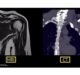 RSIP Vision presents new tool for Total Shoulder Arthroplasty (TSA) planning through MRI scan