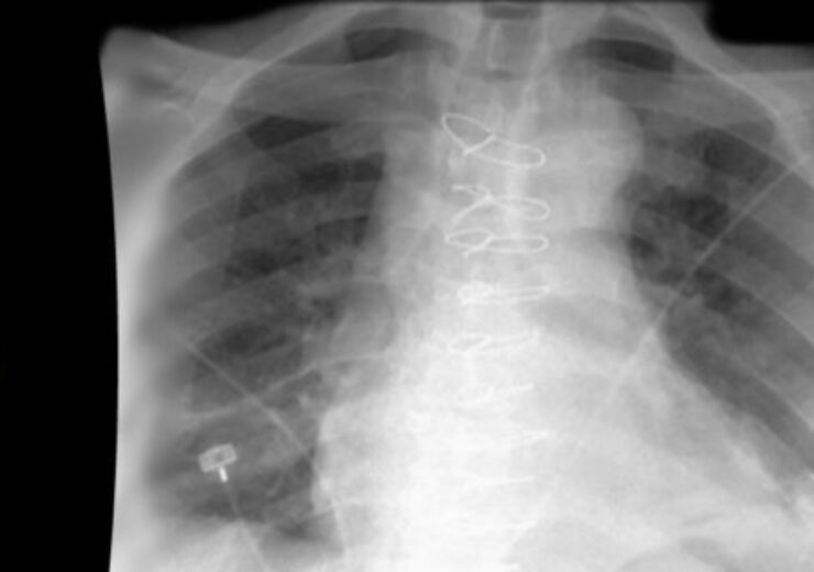 AIDOC expands AI service to X-RAY, receiving FDA 510(K) clearance for PNEUMOTHORAX