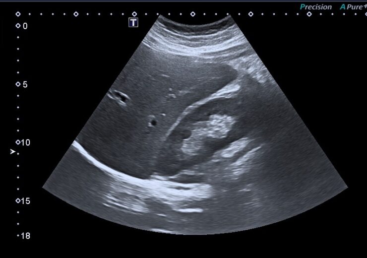 Ultrasound_liver_right_lobe_and_right_kidney