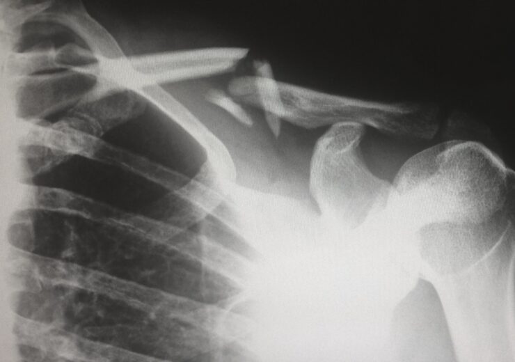 Catalyst gets FDA 510(k) approval for shoulder arthroplasty planning software