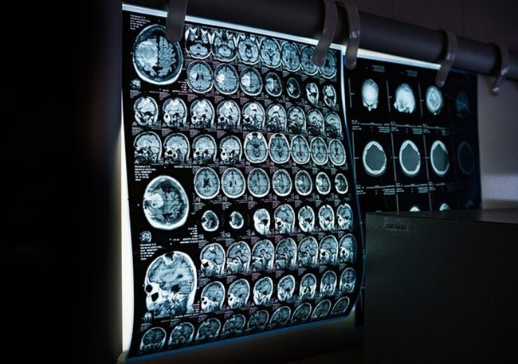 Siemens Healthineers and Cerebriu Establish R&D Partnership to Automate Neuroimaging Workflow