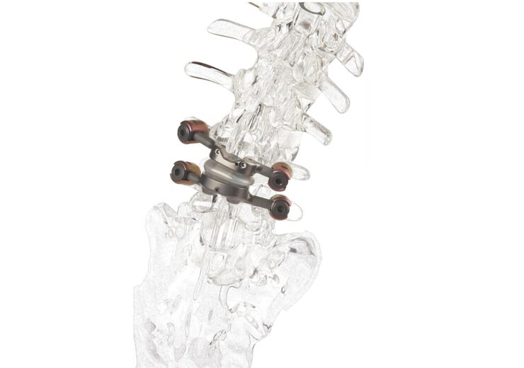 Study Data Show Premia Spine’s TOPS™ Spinal Arthroplasty System Is Cost-effective Compared With TLIF, Becomes Dominant Strategy Over Time