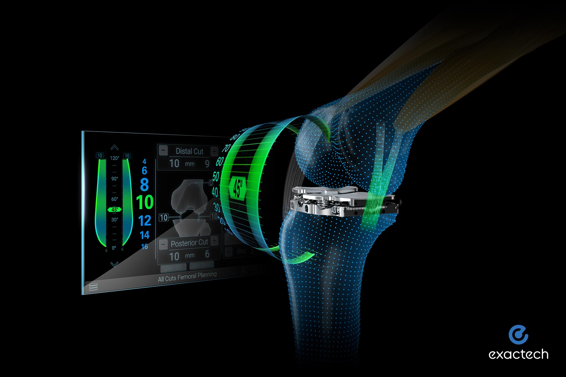 Exactech completes first surgery using Newton Balanced Knee technology