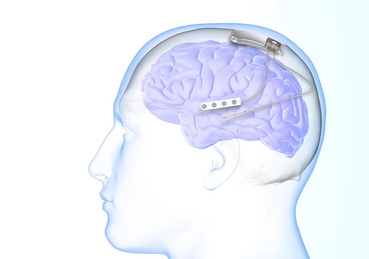NeuroPace implants first patient with RNS System in NAUTILUS study