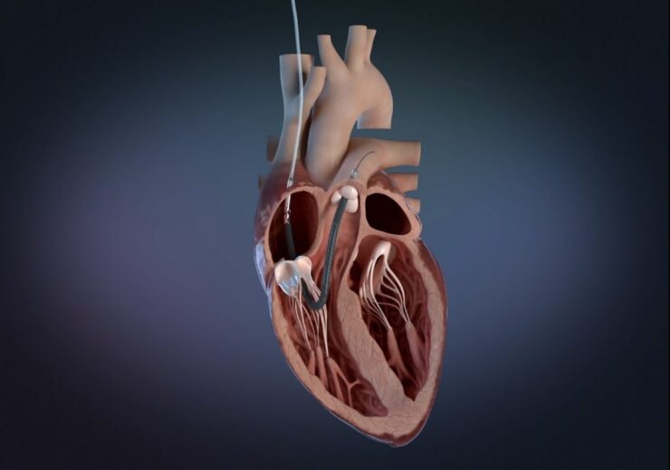 Abiomed gets FDA nod for Impella RP Flex to treat right heart failure