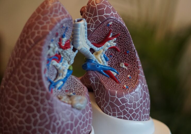 RadNet’s Aidence Artificial Intelligence (AI) Subsidiary and Google Health Enter into Collaboration to Help Improve Lung Cancer Screening with AI Solutions