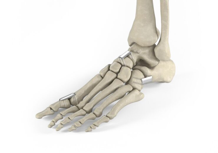 Enovis Expands Foot & Ankle Portfolio’s DynaClip Family by Introducing Procedure-Specific Staples
