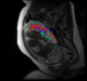 New MRI method provides detailed view of the placenta during pregnancy