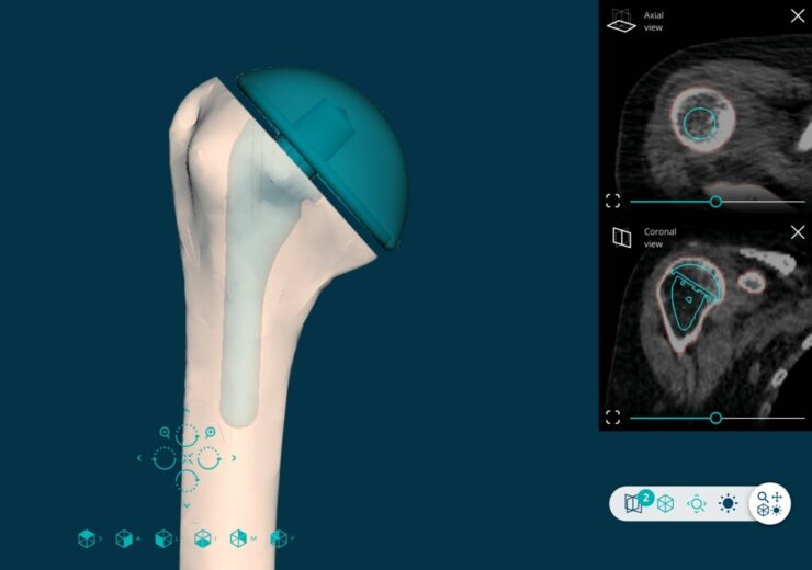 PeekMed rolls out AI-powered orthopaedic solution in US