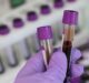 New blood test accurately detects Alzheimer’s Disease ten years early