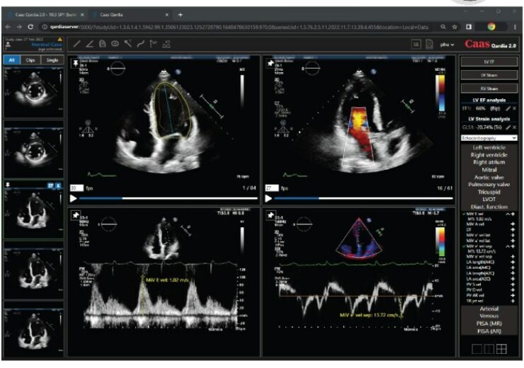 The innovative echocardiography software platform “CAAS Qardia” by Pie Medical Imaging receives medical device certification in Japan