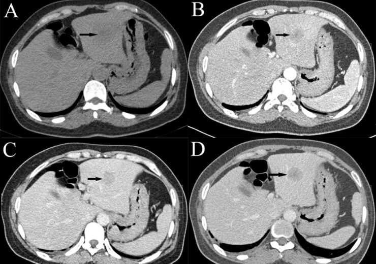 Triphasic_CT_scan_of_hepatocellular_carcinoma
