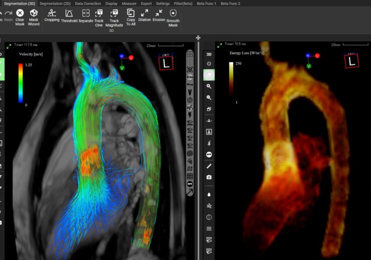 Cardio Flow Design gets FDA nod for iTFlow blood flow analysis software