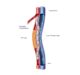 Endologix Receives FDA Approval of the DETOUR System to Treat Long Complex Superficial Femoropopliteal Lesions in Patients with PAD