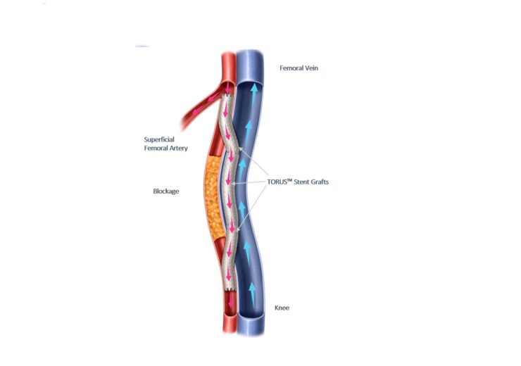 Endologix Announces First Patients Treated with the DETOUR System, Advancing Treatment for Complex Peripheral Artery Disease