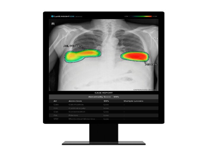 Lunit INSIGHT CXR improves radiologists’ chest X-ray analysis in study
