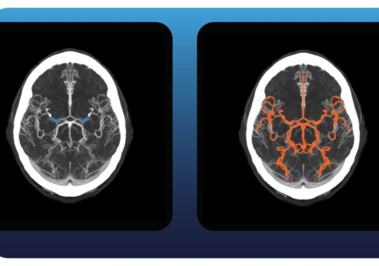 Aidoc launches AI-based Full Brain Solution for stroke detection