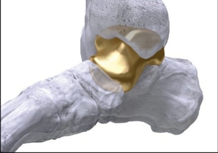 Paragon 28 Receives FDA Approval for IDE Feasibility Study of Its SMART Total Talus System for use in Conjunction with the APEX 3D Total Ankle Replacement System