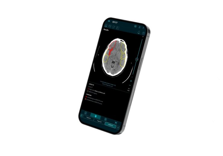 Brainomix 360 smartphone