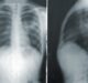 US FDA approves Bering’s AI-based chest X-ray triage solution