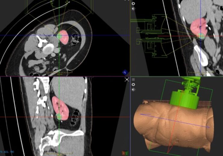 HistoSonics treats first kidney tumour patient in Edison System trial