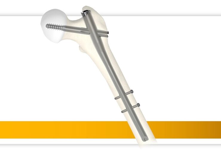 New intermediate nail and RC Lag Screw expand Gamma4 portfolio to meet the needs of surgeons and their patients