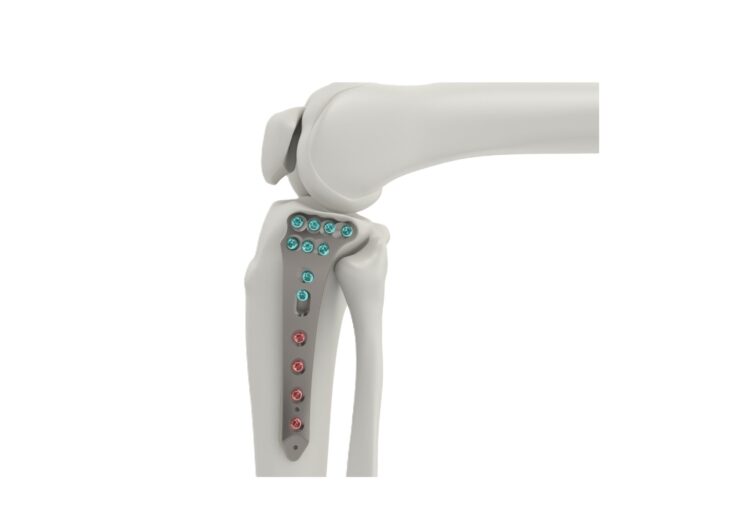 Tyber Medical Acquires FDA Clearance for Proximal Tibia Plating System