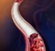 BD recruits first patient in AGILITY trial of BD Vascular Covered Stent