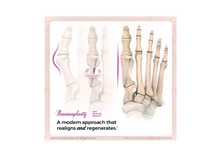 Voom Medical Devices’ Bunionplasty 360 Bunion Repair Solution Offers Modern Alternative to Traditional 3D Approaches